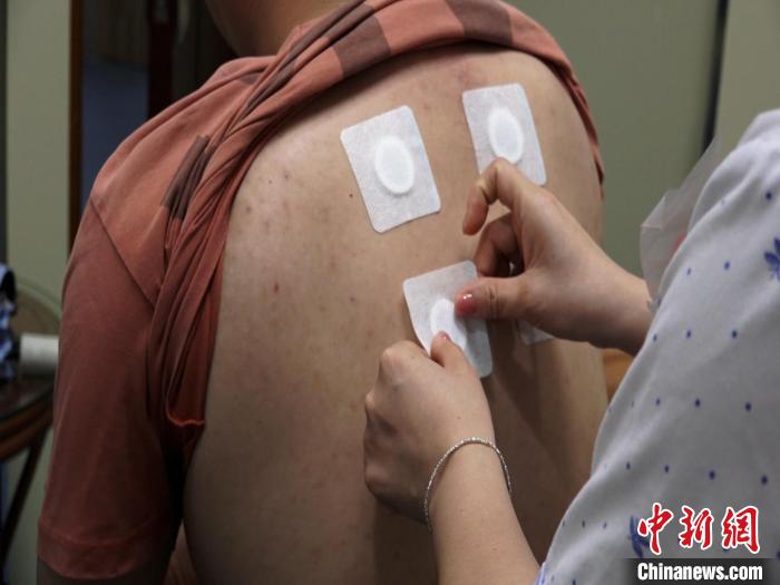 圖為醫(yī)生正在為民眾貼“三伏貼”?！√莆登?攝